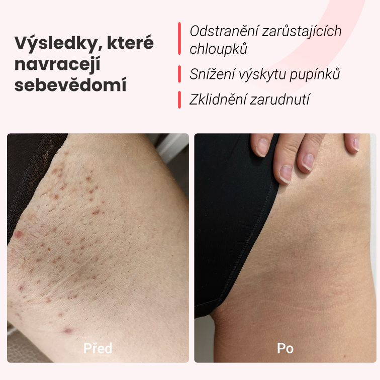 Hilda IPL epilátor