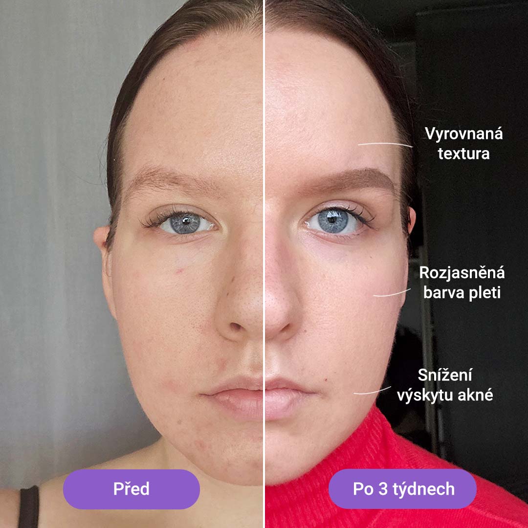 Světelná terapeutická maska Lumi