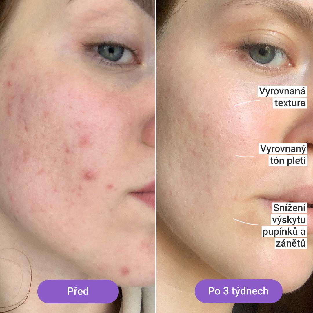 Světelná terapeutická maska Lumi